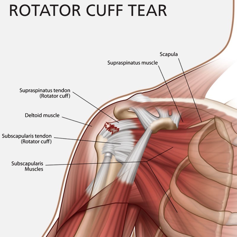 Rotator Cuff Tears  Florida Orthopaedic Institute